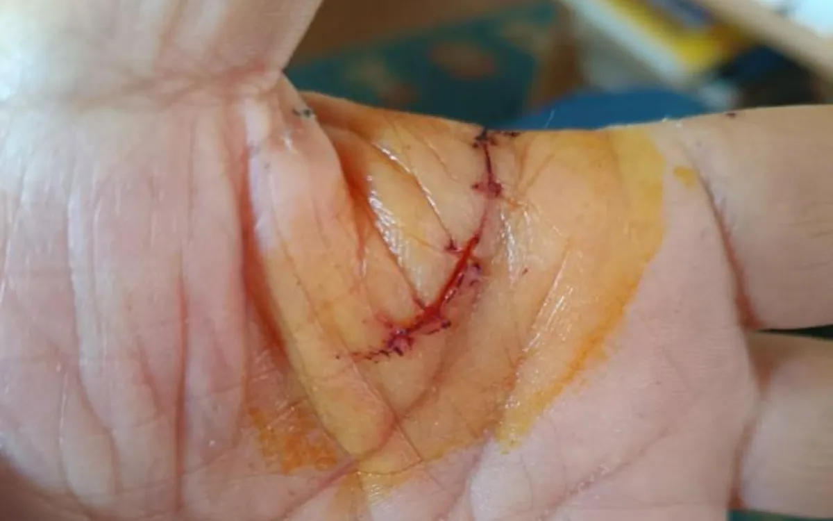 Carrefour se niega a indemnizar a Abdel, gravemente herido por la explosión de una botella de vino