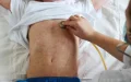 Alerta sanitaria : Brote de sarampión en Marruecos preocupa a viajeros y autoridades francesas