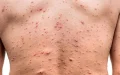 Alerta sanitaria : Marruecos detecta su primer caso de viruela del mono en Marrakech