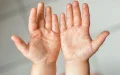 Alerta sanitaria : Sarampión mortal se extiende en Marruecos y amenaza a niños