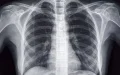 Descubren situs inversus en adolescente marroquí : La rara condición que invierte los órganos