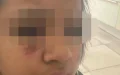 Molenbeek : Camilia, de 14 años, golpeada y quemada en la cara por ocho individuos