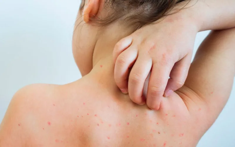 Alerta en Bruselas : Nueva variante marroquí del sarampión amenaza la salud pública