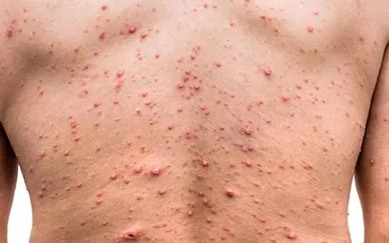 Alerta sanitaria : Marruecos detecta su primer caso de viruela del mono en Marrakech