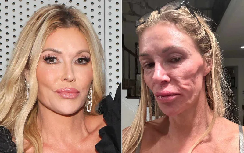 Brandi Glanville : De estrella de reality a víctima de infección marroquí