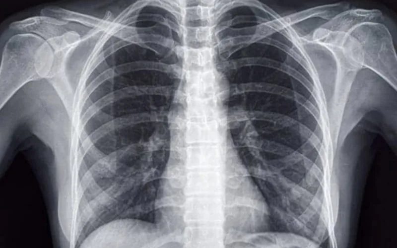 Descubren situs inversus en adolescente marroquí : La rara condición que invierte los órganos