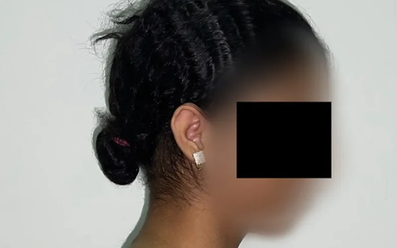Marruecos : Los cirujanos extirpan el 27% del peso de una adolescente